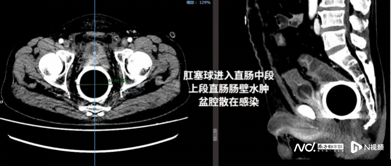 副本中年大叔直肠卡钢球，医生妙计巧取出20220613(1)(1)259.png